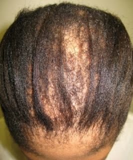 a damaged hair