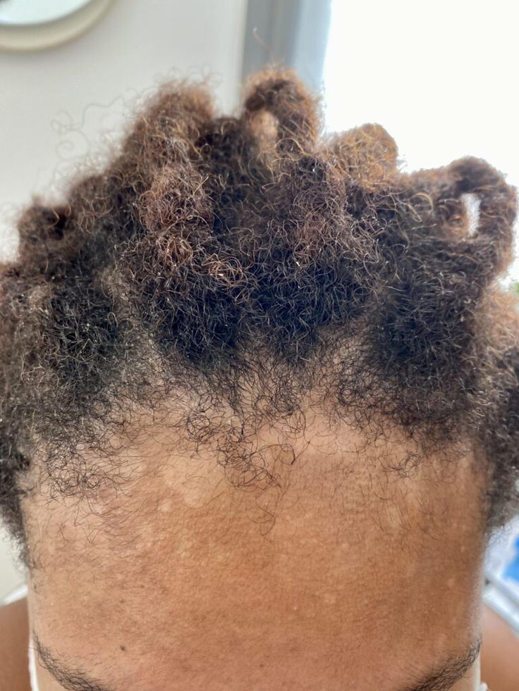 Seborrheic Dermatitis on a woman