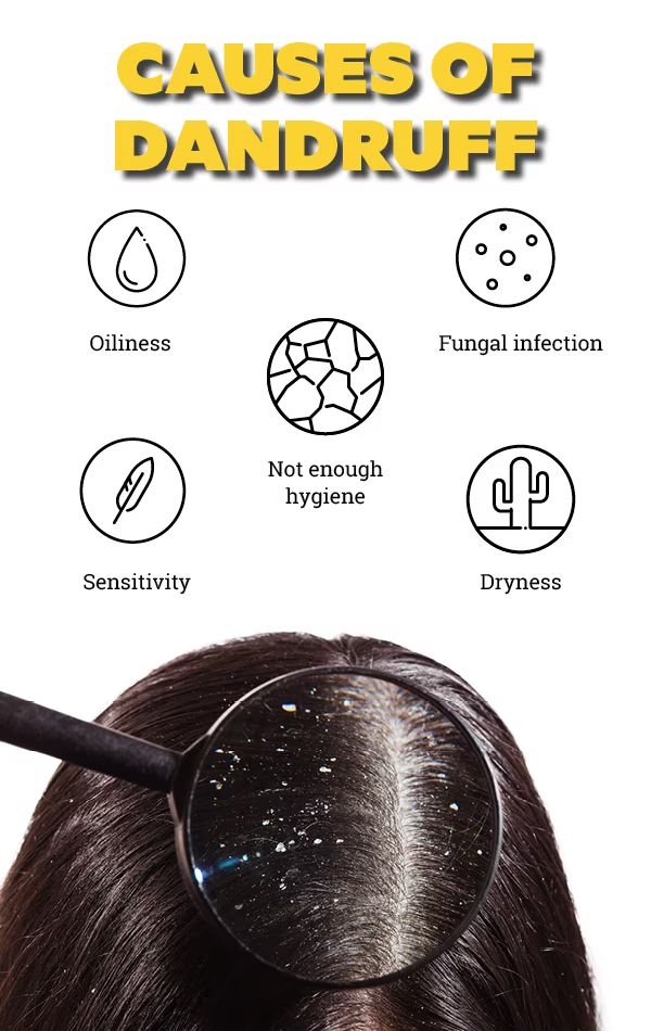 An educational graphic showing factors associated with dandruff.