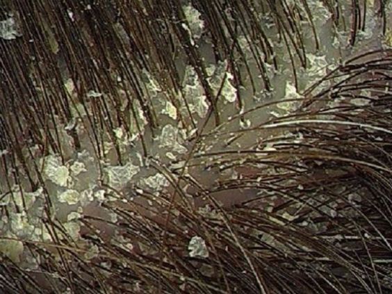 Visible dandruff flakes on the scalp