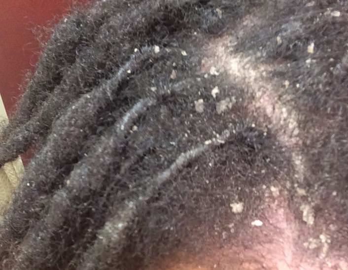 a dry loc scalp