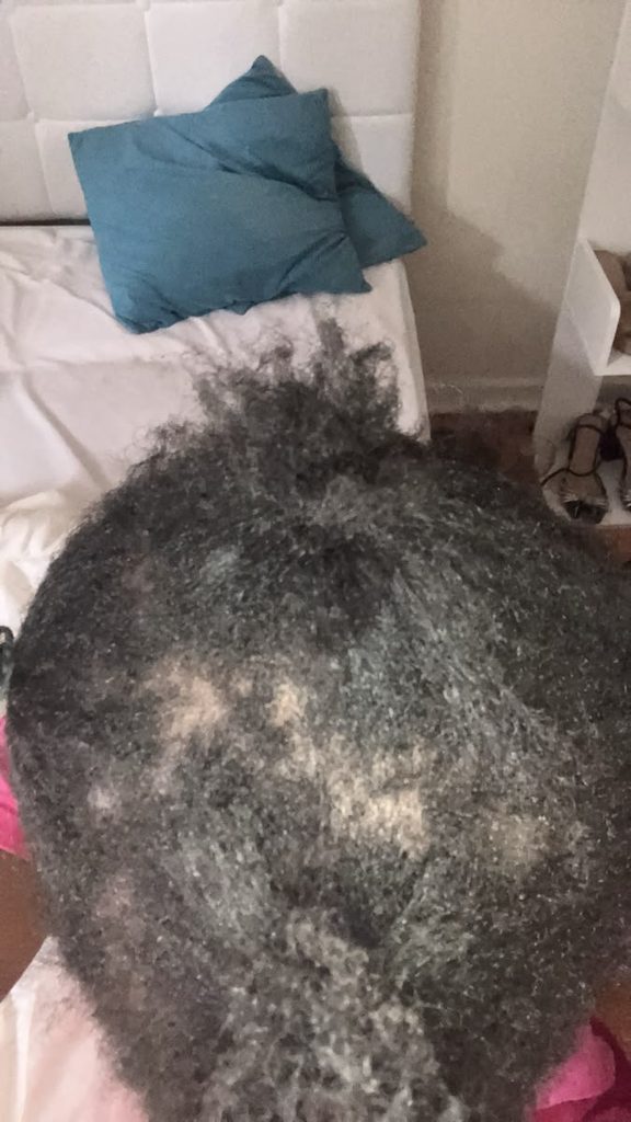 Dry scalp requiring extra care
