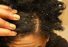 Dry scalp with natural hair