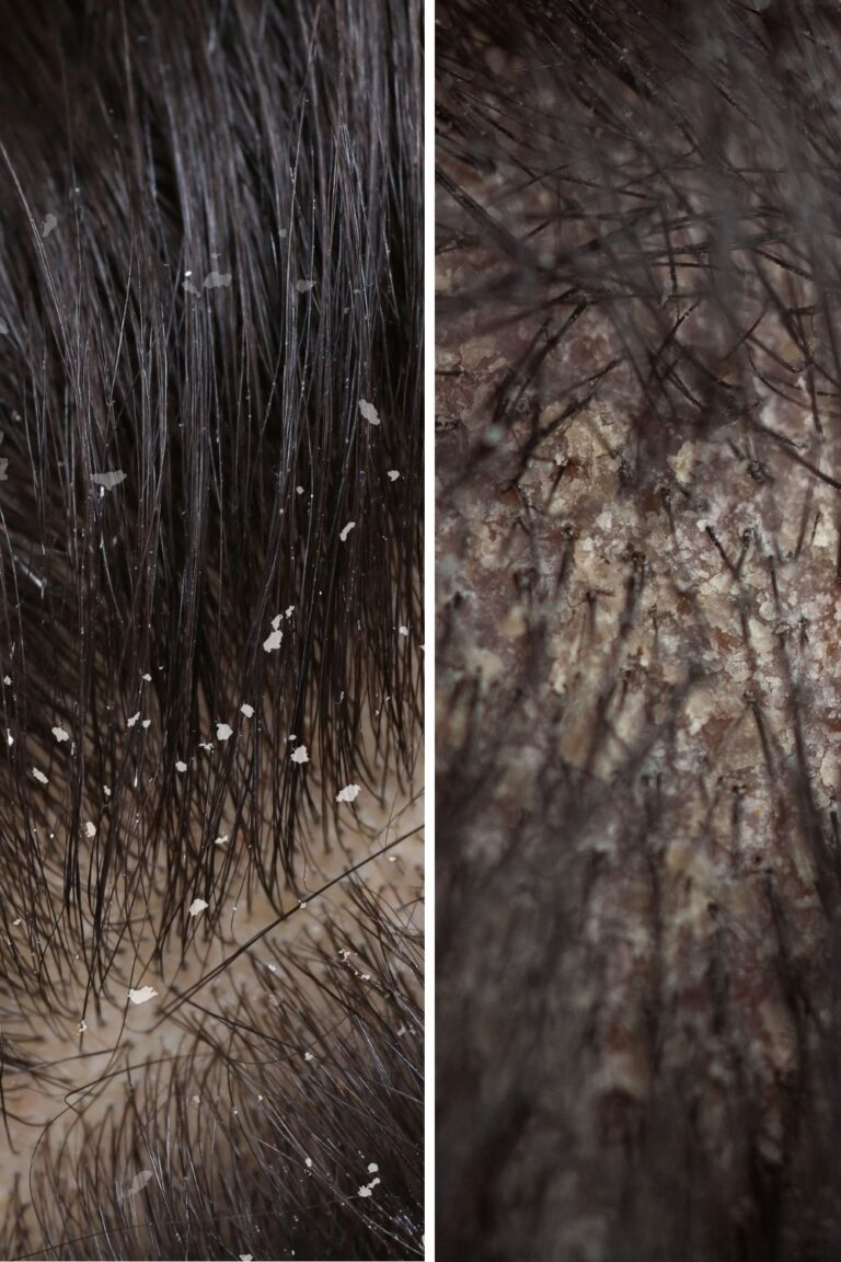 Dry Scalp vs Dandruff: What’s the Difference?