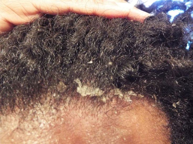 Excessive scalp flaking in natural hair