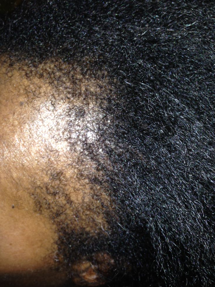 Close-up of Black woman's natural hairline with short regrowth and fragile edges