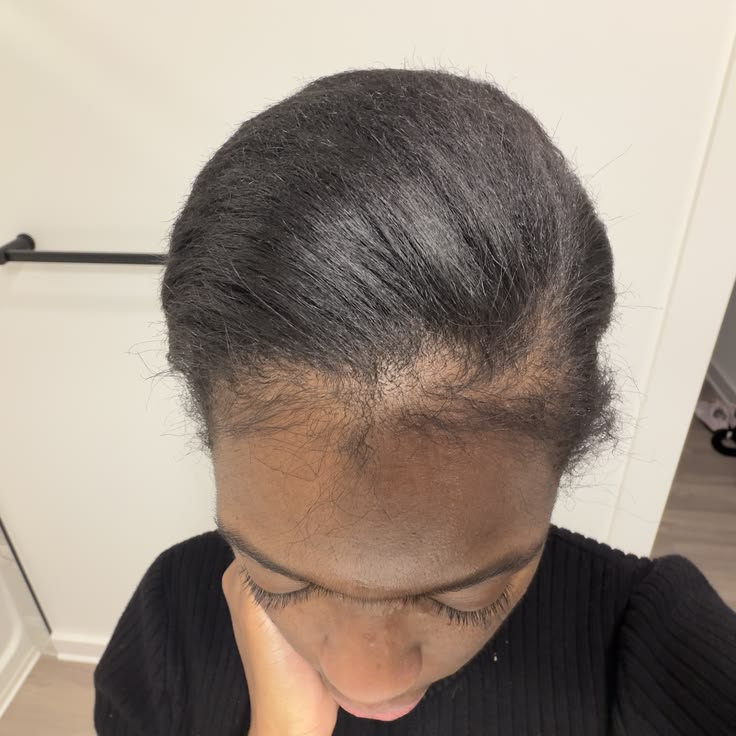 Woman examining noticeable hairline thinning