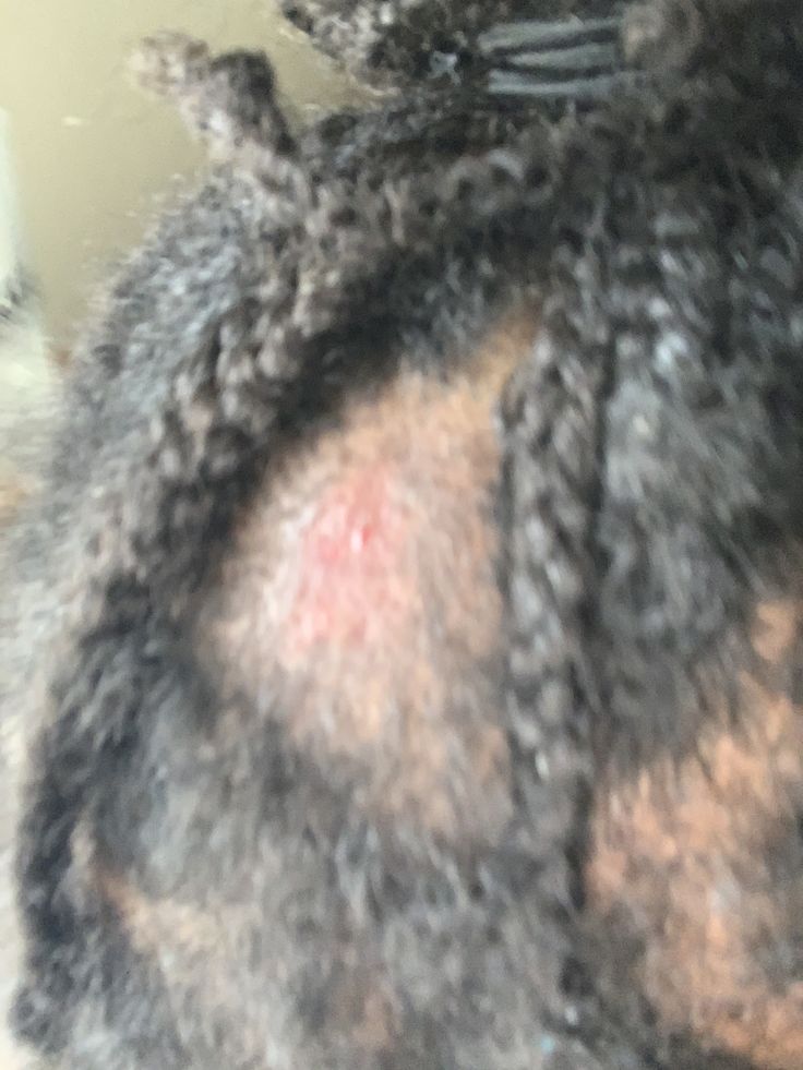 Signs of scalp redness and inflammation