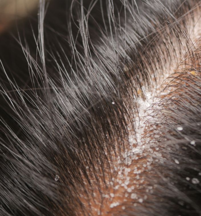 a oily scalp