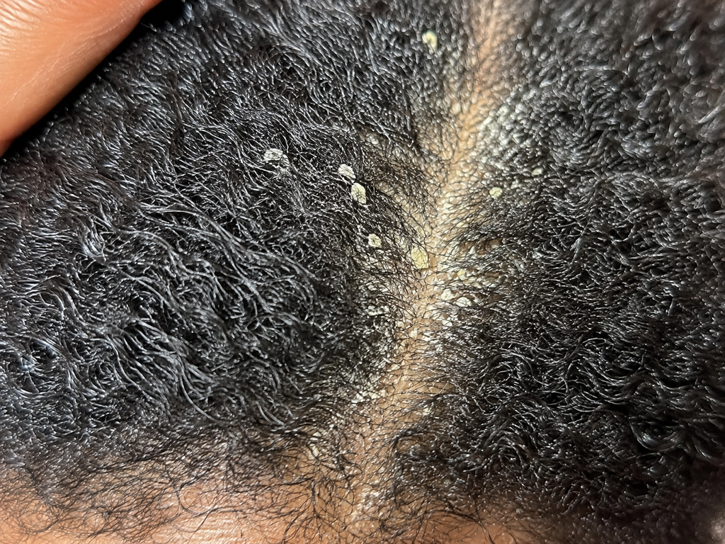 Product buildup on a natural hair scalp