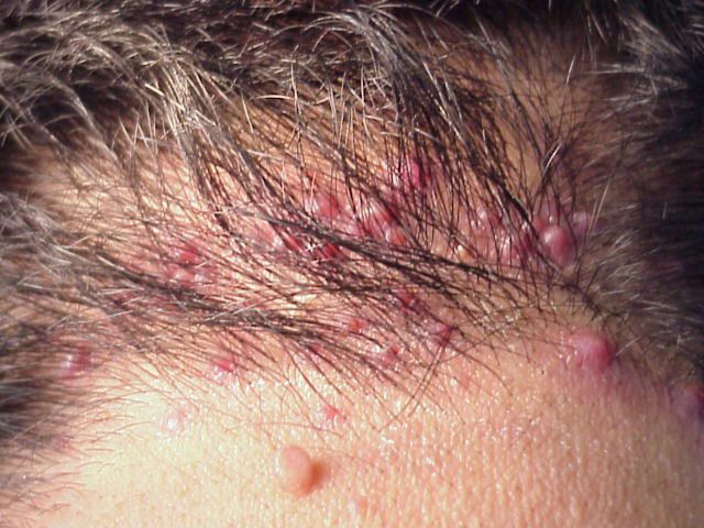 scalp bumps