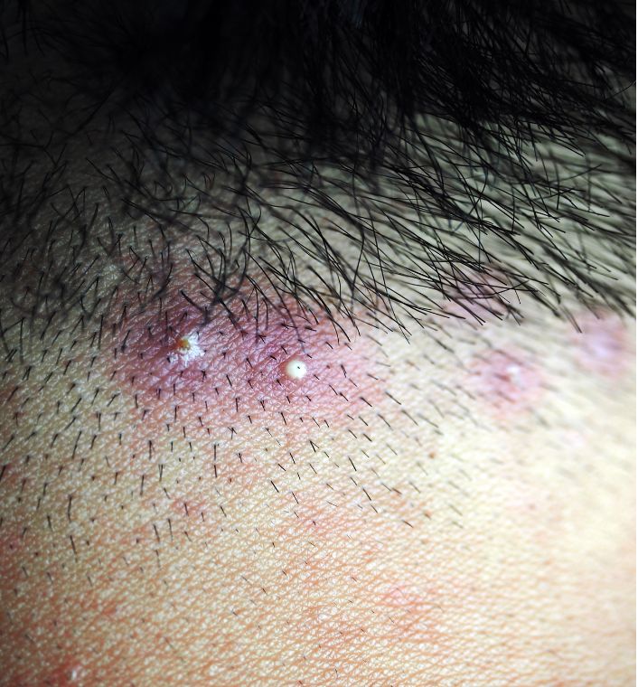 scalp bumps