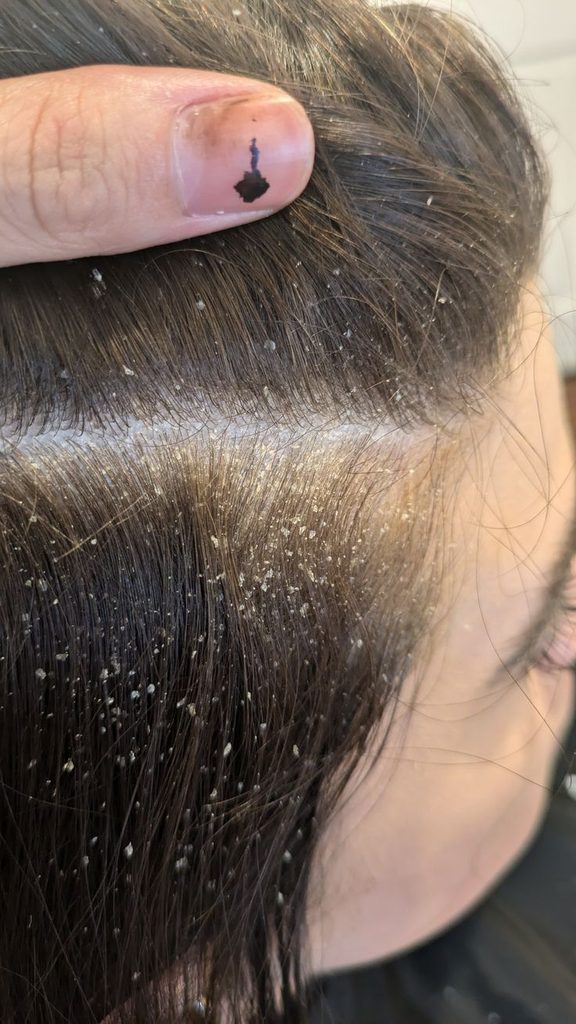 close-up illustrating mild dry scalp and fine flakes.