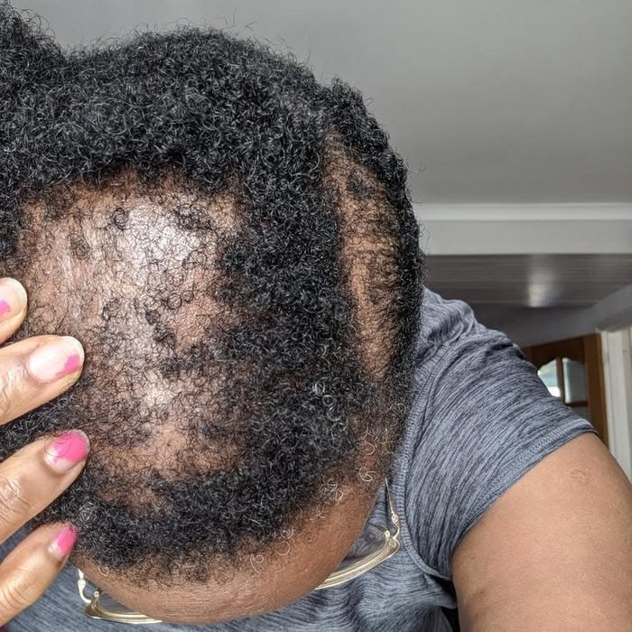 A woman with unexplained hair loss